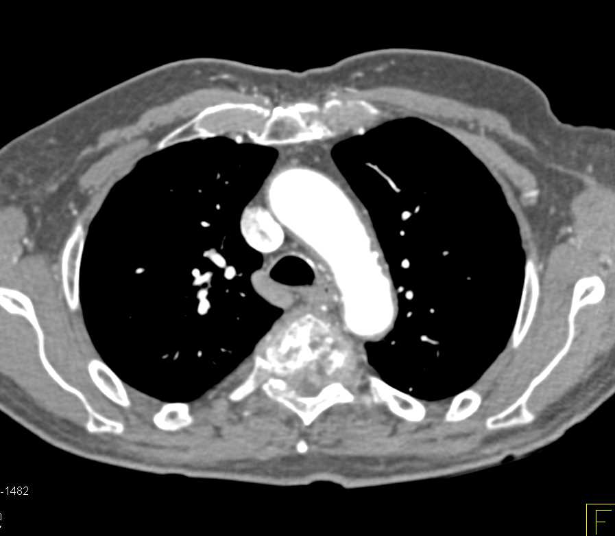Osteomyelitis T-Spine - CTisus CT Scan