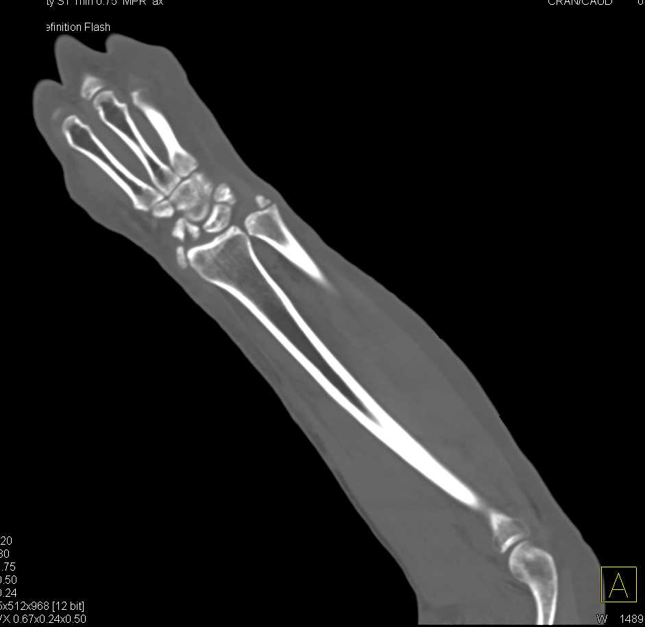 Fracture Dislocation Wrist Post Trauma - CTisus CT Scan