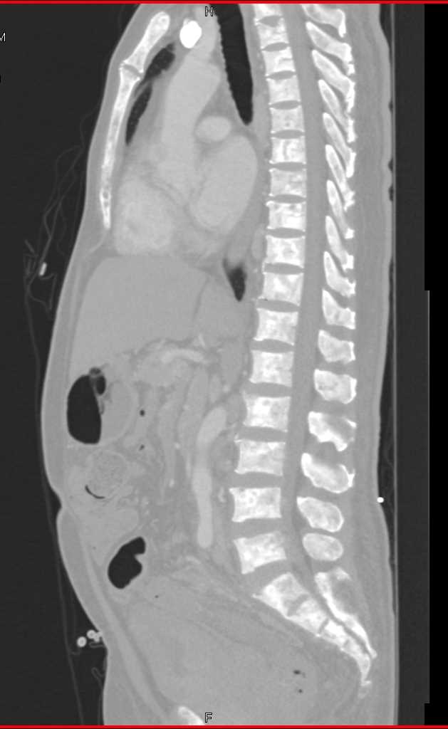 Blastic Bone Metastases - CTisus CT Scan