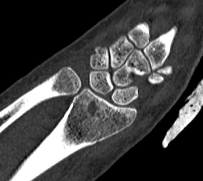 Distal Radial Fracture - CTisus CT Scan