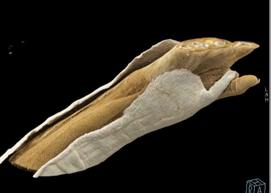 Distal Radial Fracture in Cast - CTisus CT Scan