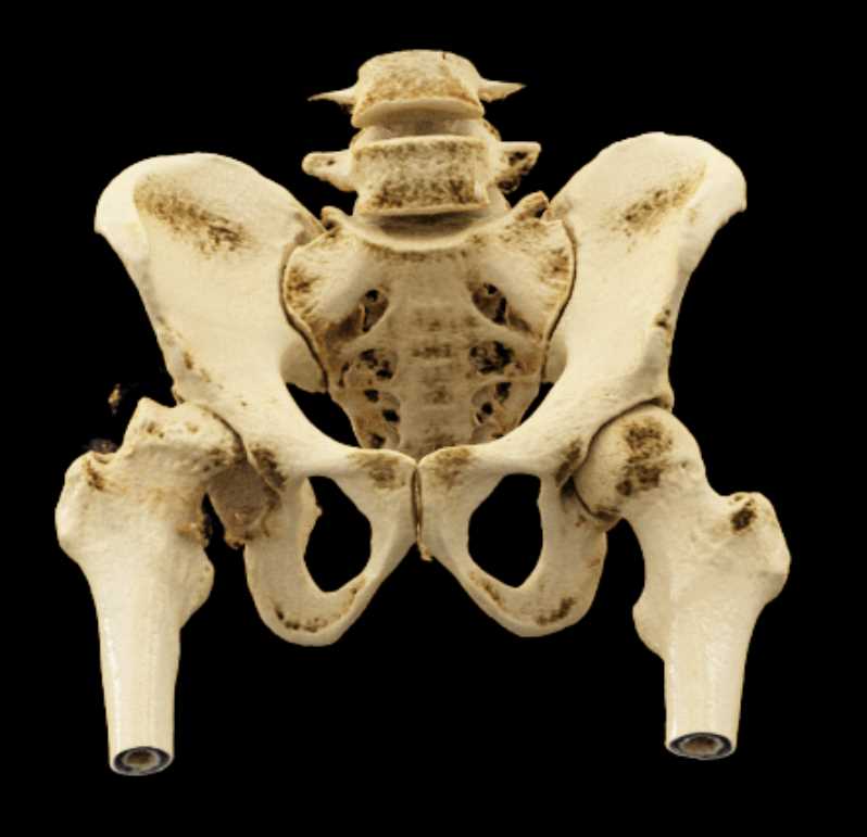 Avascular Necrosis and Degenerative Joint Disease (DJD) Right Femur and Hip Joint - CTisus CT Scan