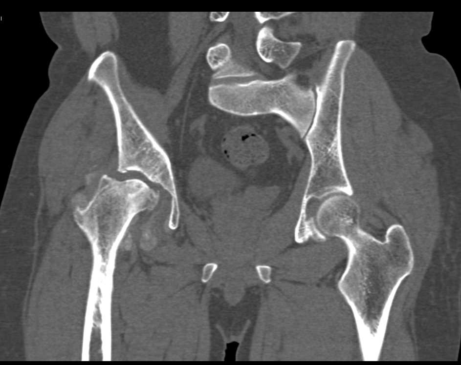 Deformity Right Femoral Head - CTisus CT Scan