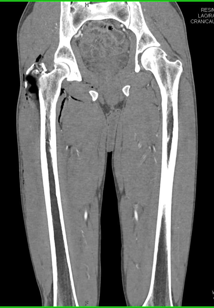 Right Greater Trochanter Fracture - CTisus CT Scan