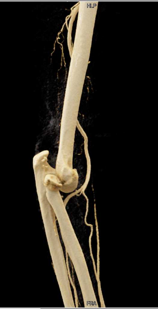 Fracture Dislocation Elbow Joint - CTisus CT Scan