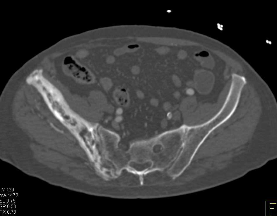 Pagets Disease - CTisus CT Scan