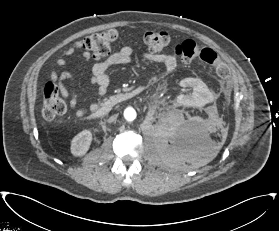 Bleed into the Left Psoas Muscle - CTisus CT Scan
