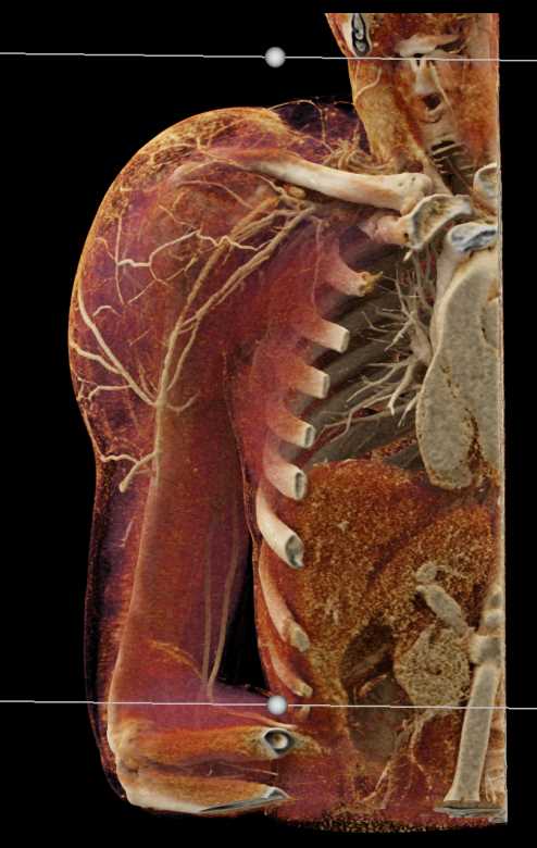Sarcoma Right Shoulder with Cinematic Rendering - CTisus CT Scan