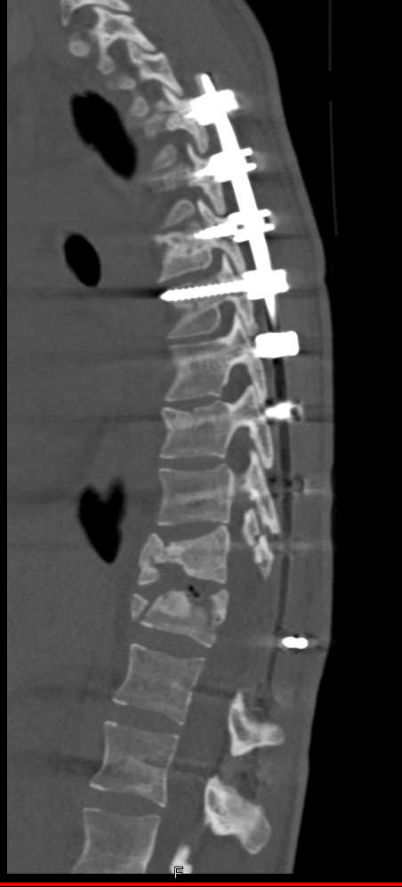 Thoracic Spine Fractures - CTisus CT Scan