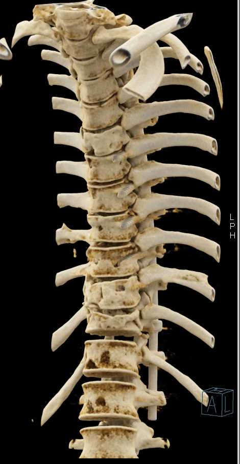 Thoracic Spine Fractures with Rods - CTisus CT Scan