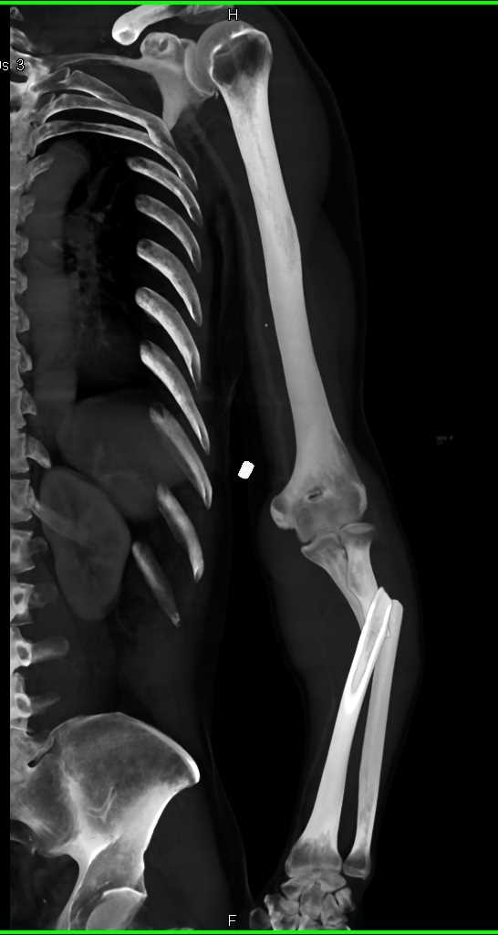 Radius and Ulnar Fractures Without Vascular Injury - CTisus CT Scan