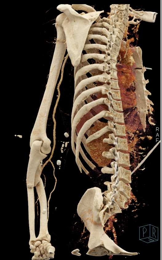 Radius and Ulnar Fractures Without Vascular Injury - CTisus CT Scan