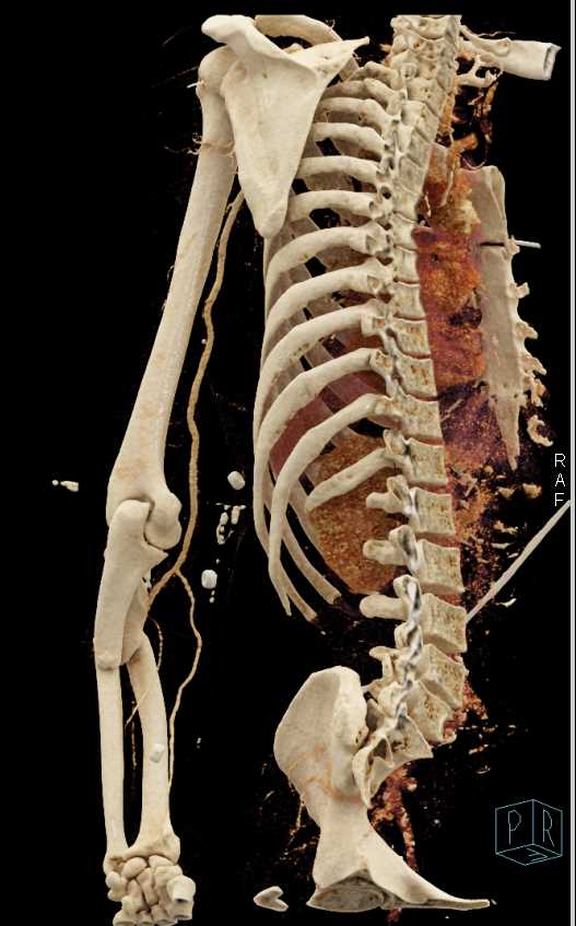 Radius and Ulnar Fractures Without Vascular Injury - CTisus CT Scan