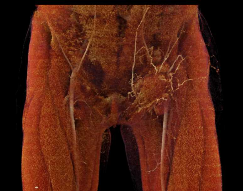 Left Groin Abscess with Pseudoaneurysm with Cinematic Rendering - CTisus CT Scan