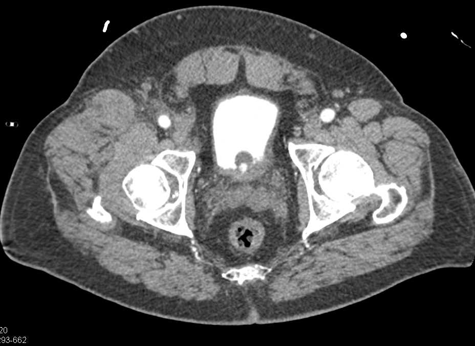 Hematoma Right Upper Thigh with Active Bleed - CTisus CT Scan