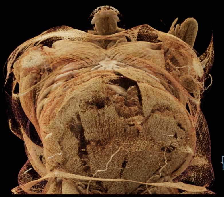 Hematoma Left Breast - CTisus CT Scan