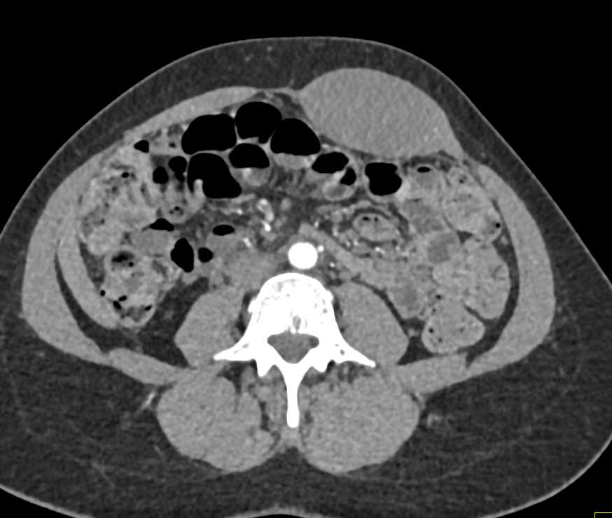 Left Rectus Hematoma - CTisus CT Scan