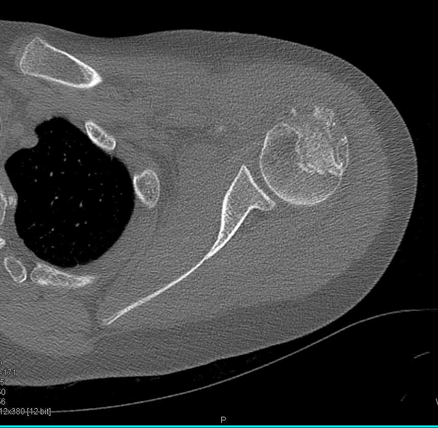 Humerus Fracture - CTisus CT Scan