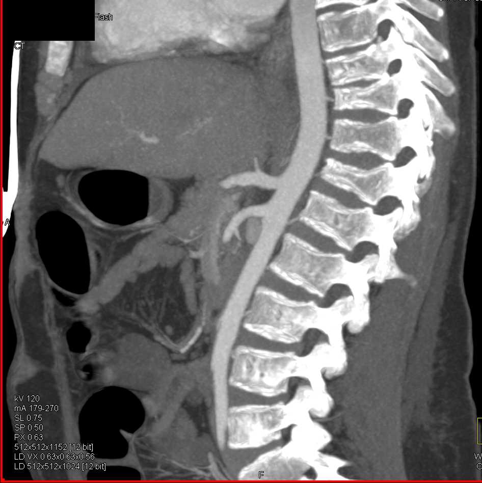 Deformed Vertebral Bodies in Hematologic Disease - CTisus CT Scan