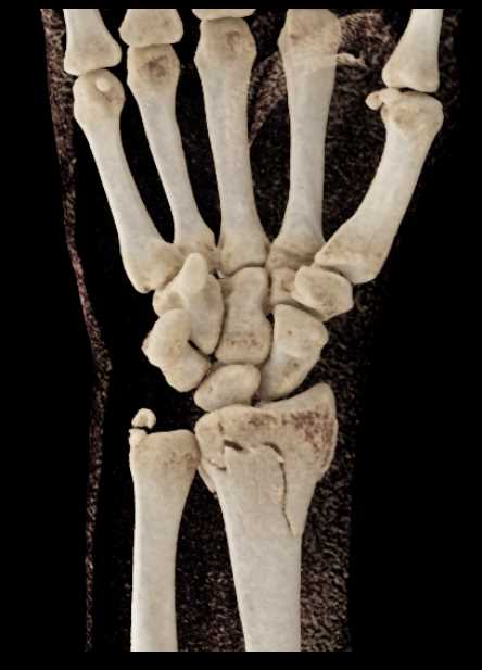 Distal Radius and Ulnar Fracture - CTisus CT Scan