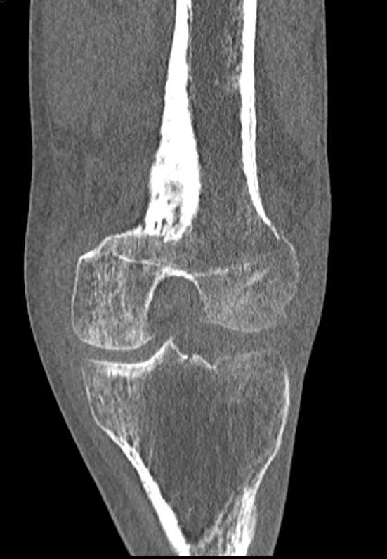 Femur and Tibial Fractures - CTisus CT Scan