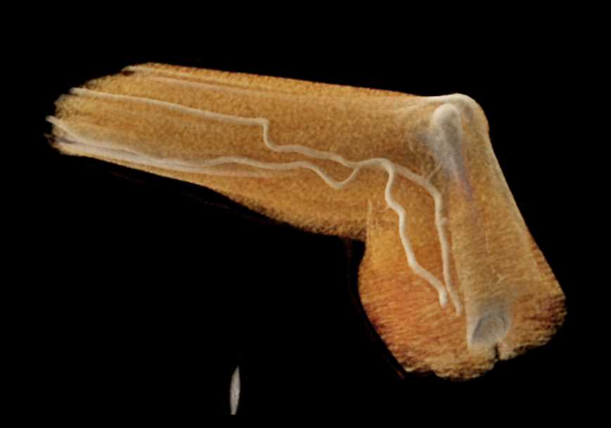 Exostosis Humerus with Vascular Mapping - CTisus CT Scan