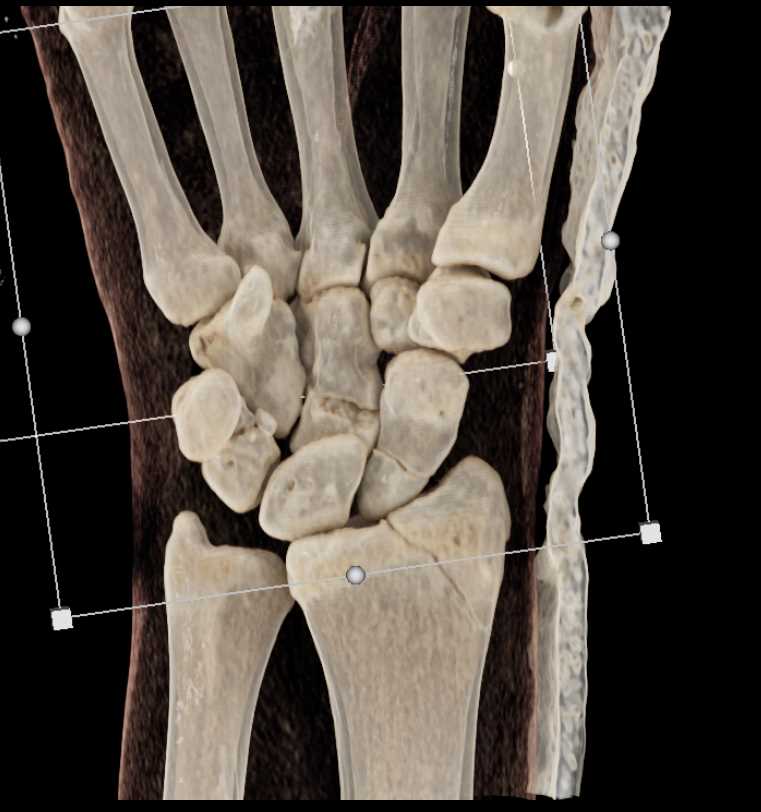 Multiple Carpal Fractures Including Scaphoid and Distal Radius on CR - CTisus CT Scan