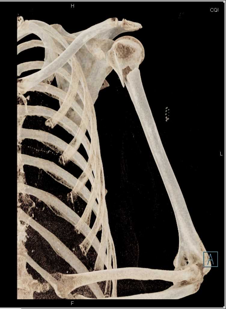 Fracture Neck of the Humerus - CTisus CT Scan