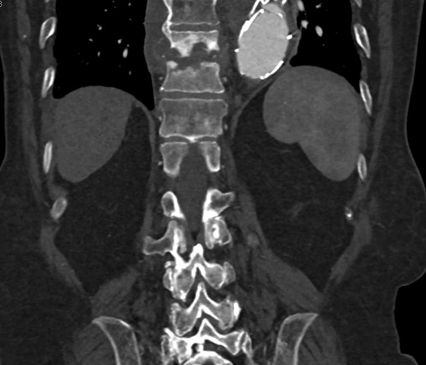 Prior Osteomyelitis T-Spine - CTisus CT Scan