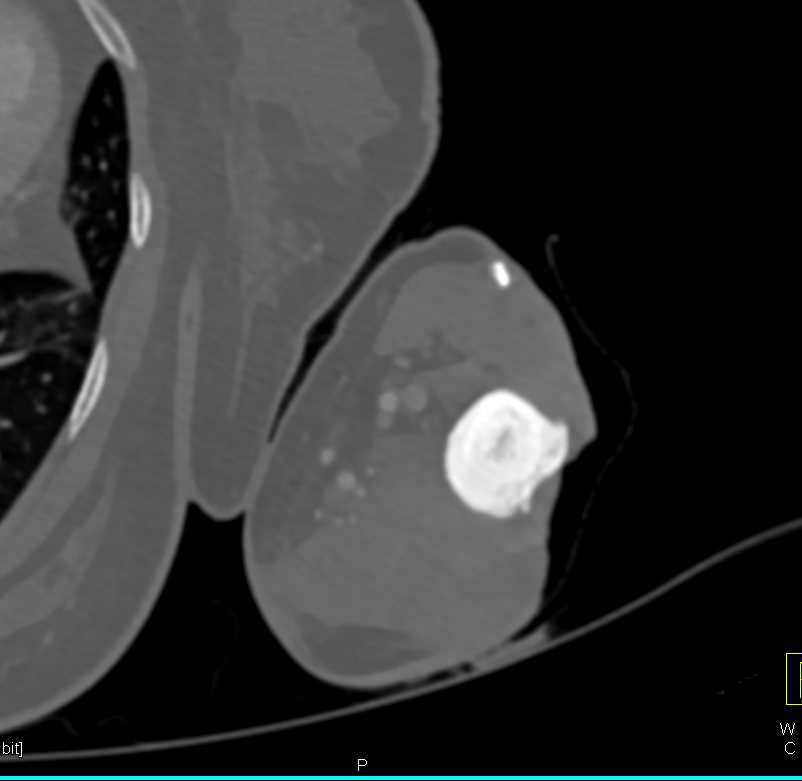 Chronic Osteomyelitis Left Humerus - CTisus CT Scan