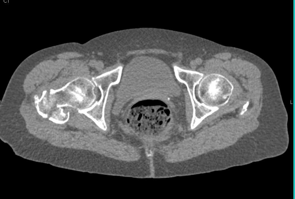 Right Femoral Neck Fracture - CTisus CT Scan