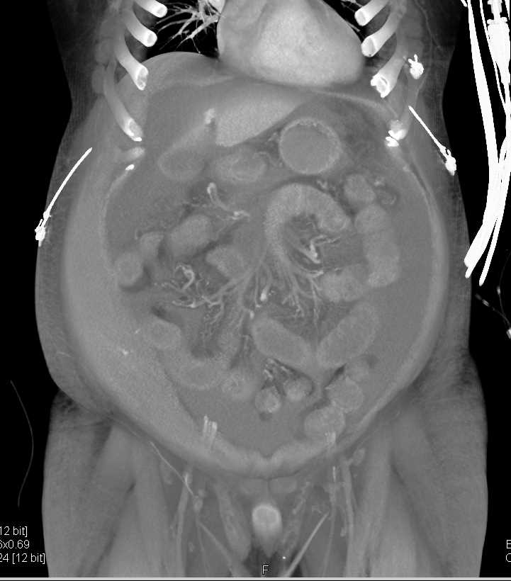 Active Bleed in the Right Abdominal Wall - CTisus CT Scan