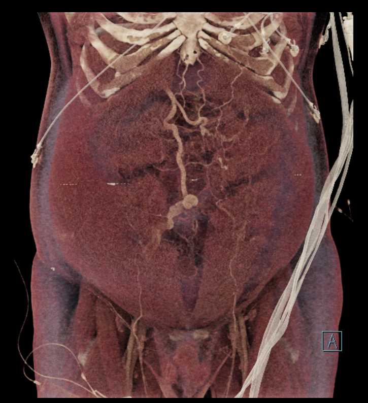 Active Bleed in the Right Abdominal Wall and Cirrhosis with Varices - CTisus CT Scan