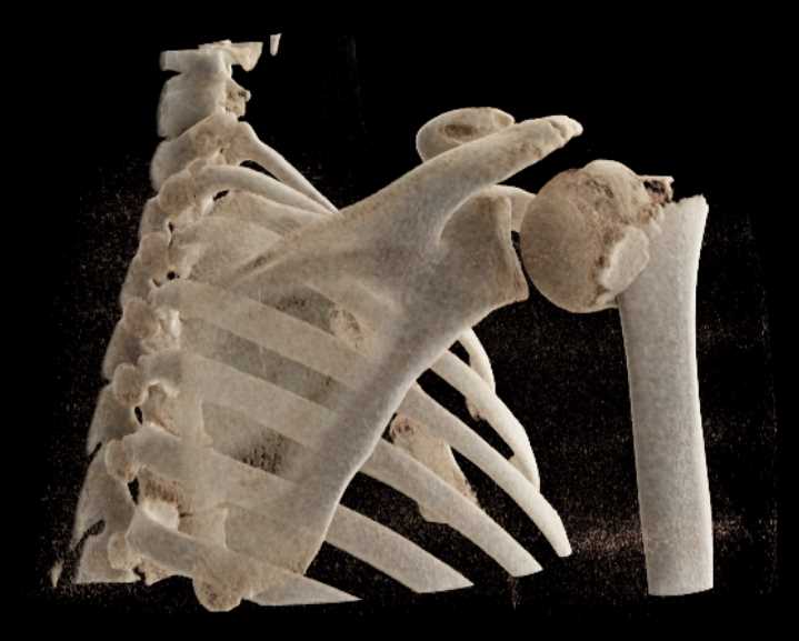 Fracture of the Humerus Neck - CTisus CT Scan