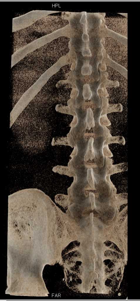 Cinematic Rendering of the Lumbar Spine Pre Myelogram - CTisus CT Scan