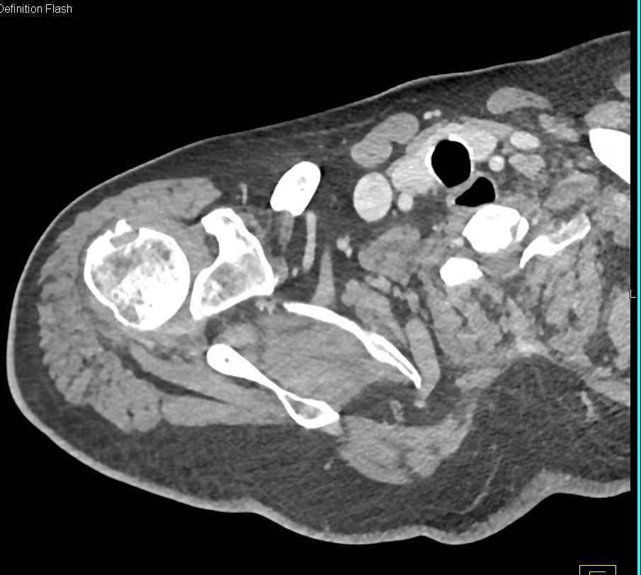 Humerus Fracture - CTisus CT Scan