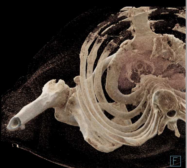 Bone Infarction Humeral Head - CTisus CT Scan