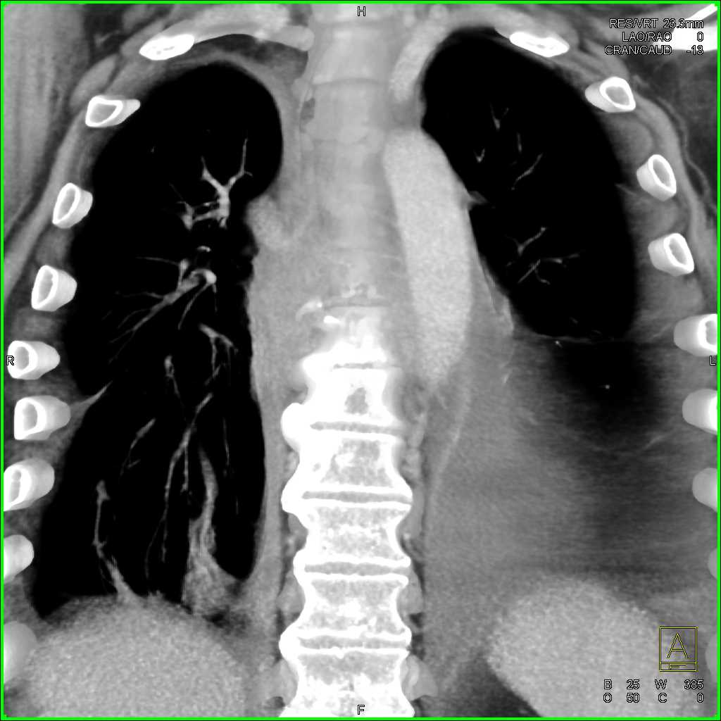 Osteomyelitis and Paraspinal Abscess T-Spine - CTisus CT Scan