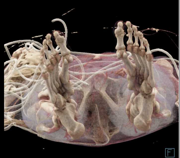 Rhabdomyolitis Left Pelvis Post Trauma - CTisus CT Scan