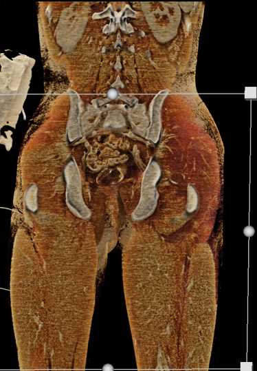 Rhabdomyolitis Left Pelvis Post Trauma - CTisus CT Scan