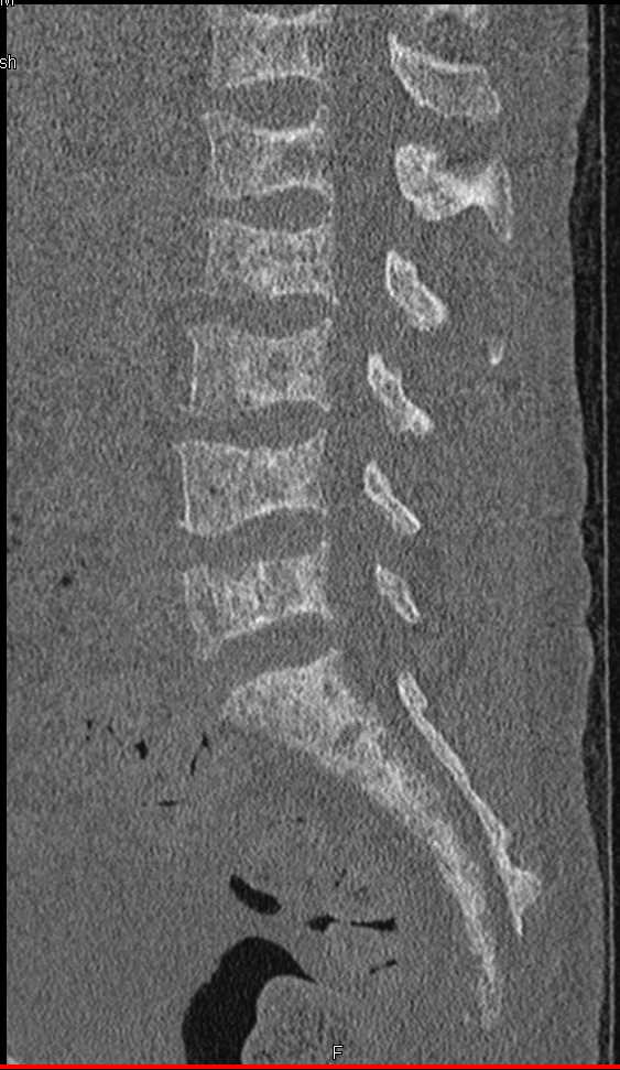 Renal Osteodystrophy - CTisus CT Scan
