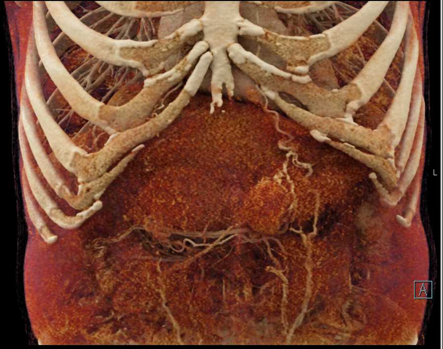 Desmoid Tumor Abdominal Wall - CTisus CT Scan