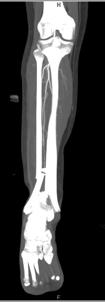 Fractures of the Tibia and Fibula - CTisus CT Scan