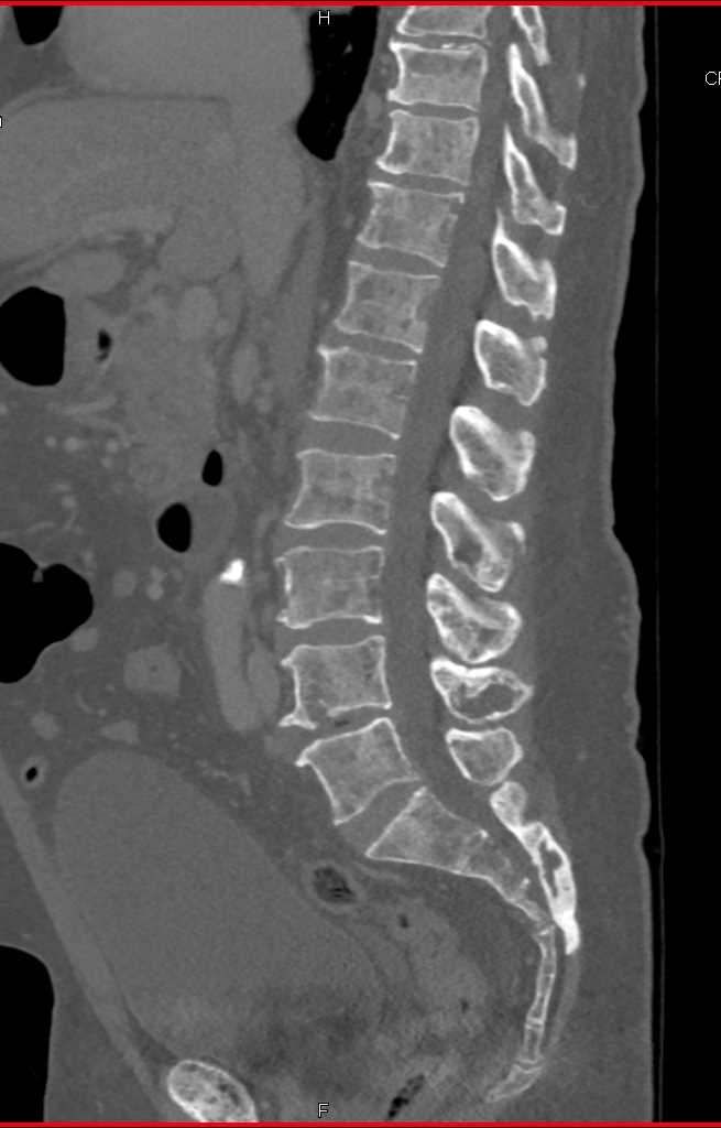 Multiple Myeloma - CTisus CT Scan