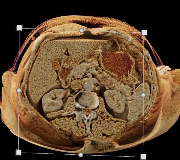Abscess in Paraspinal Region - CTisus CT Scan
