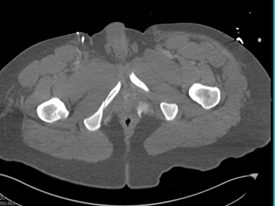 Multiple Fractures Including Right Humerus - CTisus CT Scan