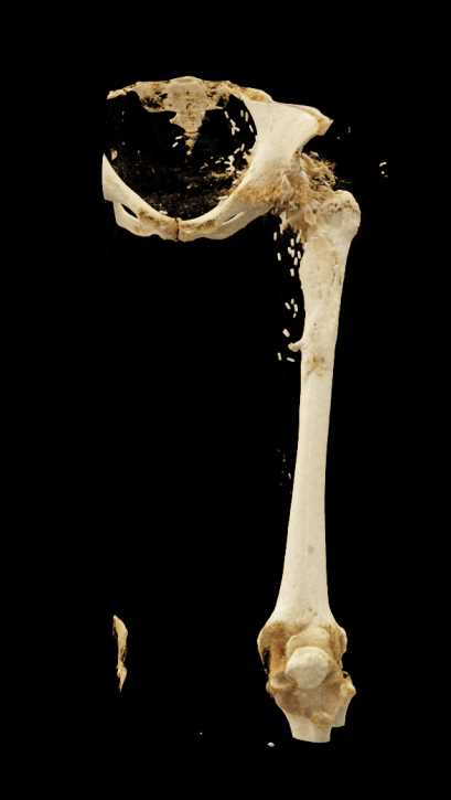 Left Total Hip Replacement - CTisus CT Scan