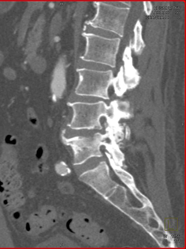 CTisus CT Scanning | Infection at L4-L5 interspace