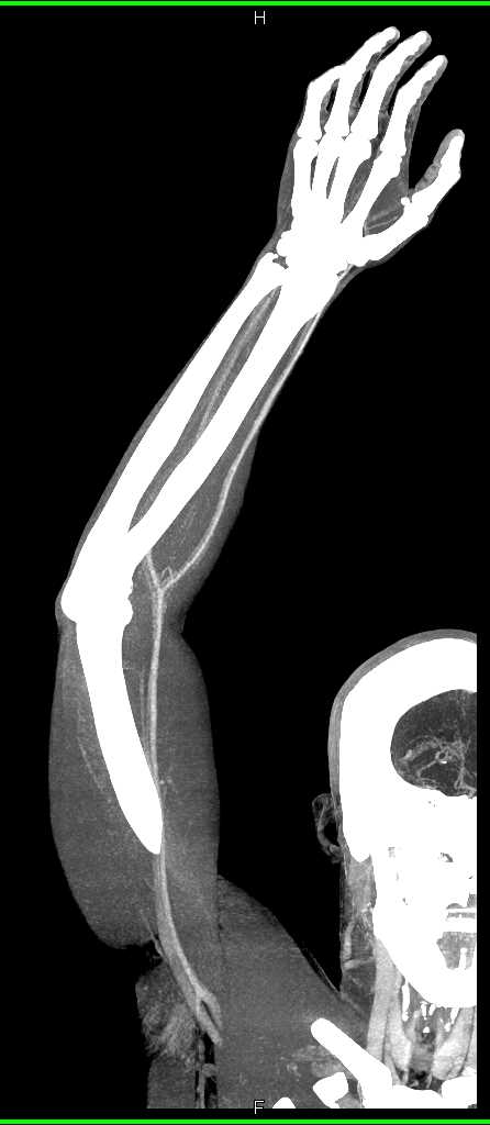 Soft Tissue Injury with Patent Vessels - CTisus CT Scan