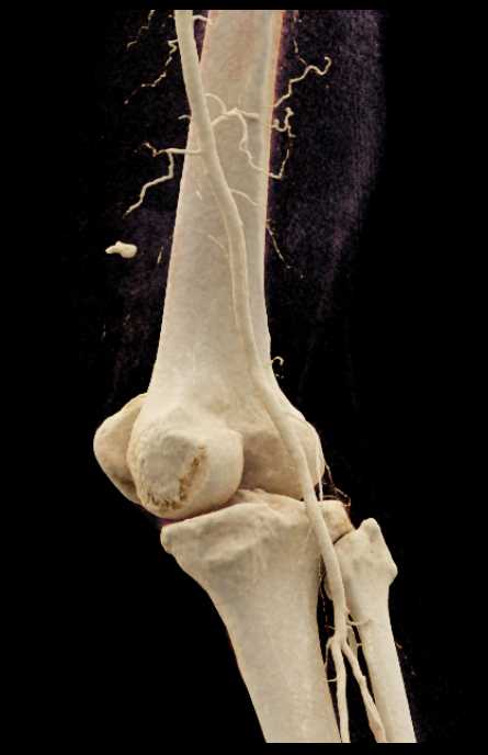 CTisus CT Scanning | GSW with Bleed Near Knee
